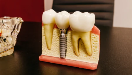 Premium Dental Implant Placement