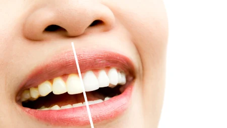 Laser Teeth Whitening