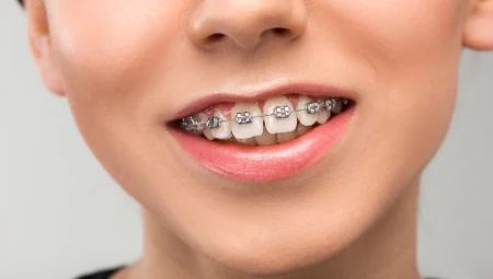 Aesthetic Orthodontics & Aligners