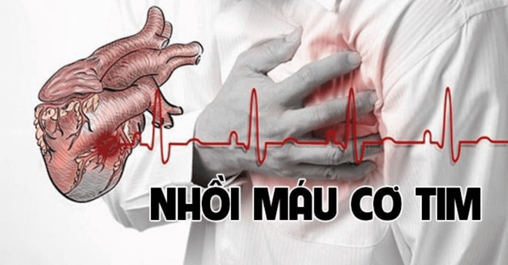 Cách phòng ngừa nhồi máu cơ tim