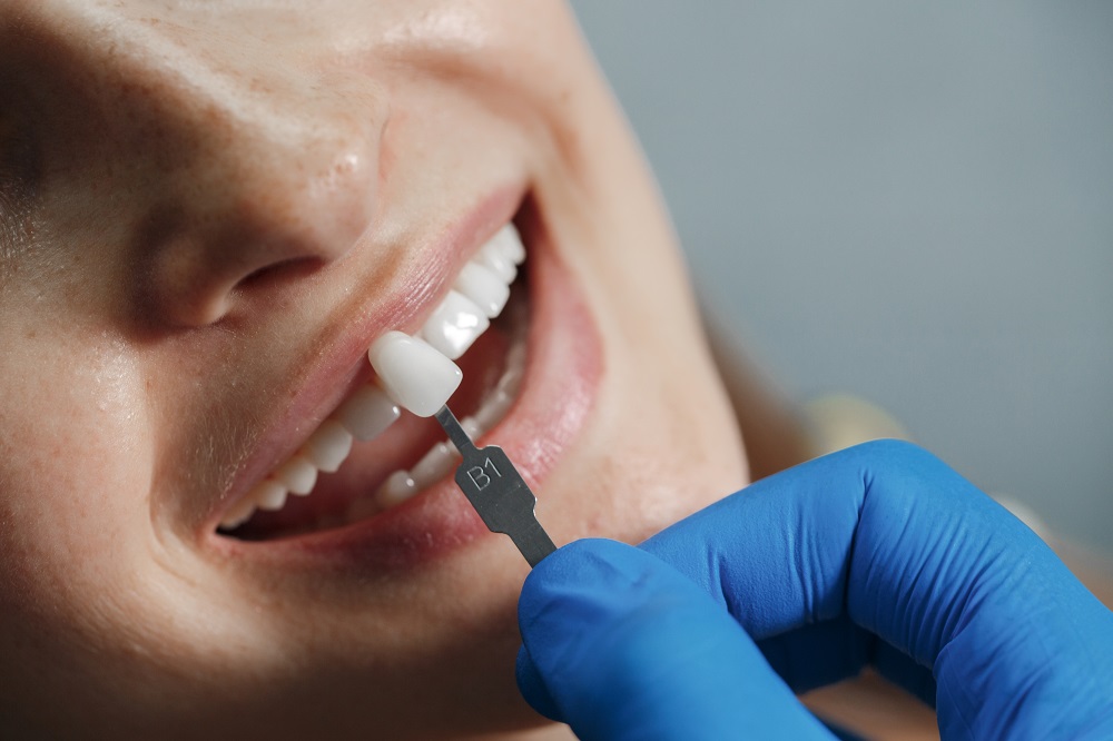 Dịch vụ dán veneer sứ cho răng