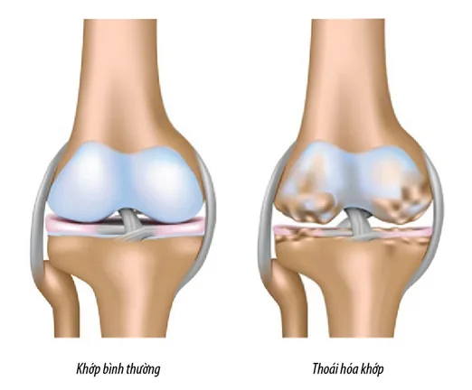 Comprehensive Overview of Knee Osteoarthritis - SANTE Hospital, Binh Thanh, HCMC Comprehensive Overview of Knee Osteoarthritis - SANTE Hospital, Binh Thanh, HCMC