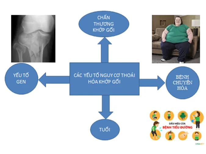 Overview of Knee Osteoarthritis - Image 2 - SANTE Hospital, Binh Thanh, HCMC Overview of Knee Osteoarthritis - Image 2 - SANTE Hospital, Binh Thanh, HCMC