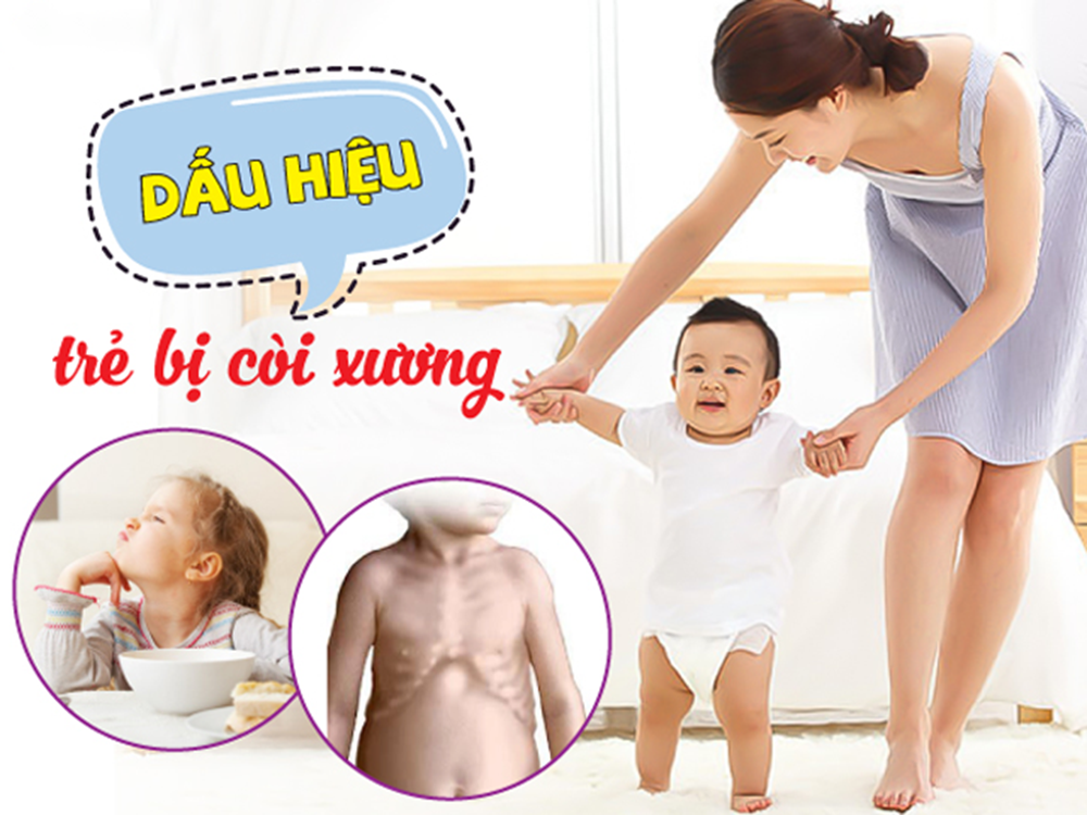 Bệnh còi xương ở trẻ em 2