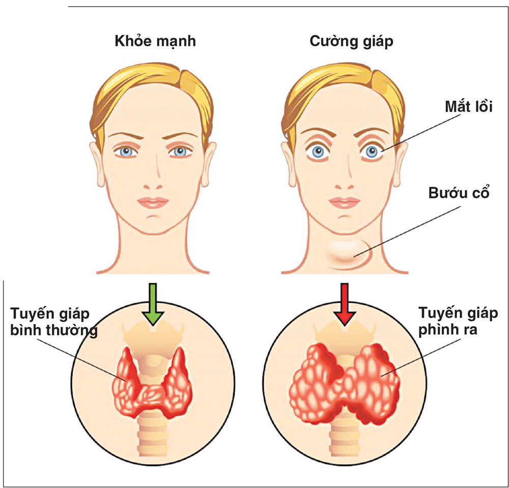 Bướu cổ nguyên nhân và cách phòng tránh 2