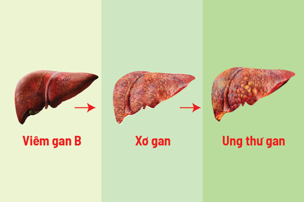 Dấu hiệu nhận biết xơ gan và ung thư gan 