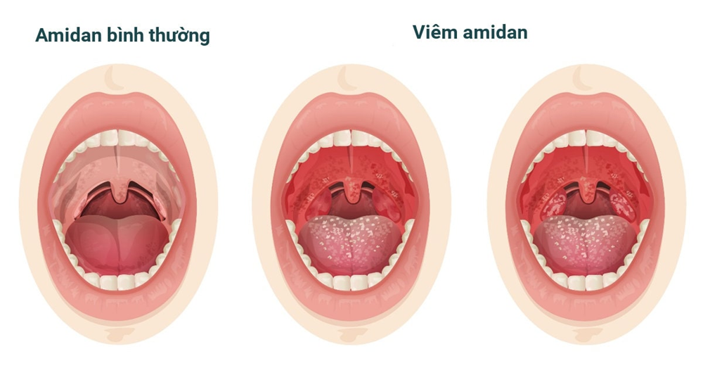 Đau họng nguyên nhân và cách điều trị 3