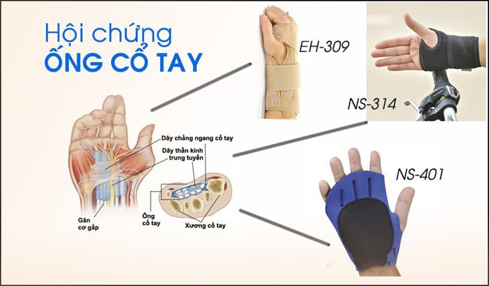 Hội chứng ống cổ tay 3