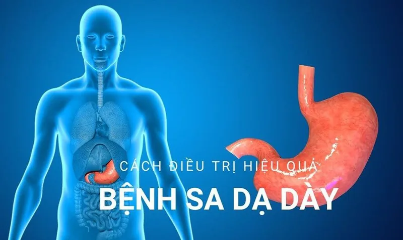 Bệnh viện Sante - Sa dạ dày - Nguyên nhân triệu chứng và cách điều trị Bệnh viện Sante - Sa dạ dày - Nguyên nhân triệu chứng và cách điều trị