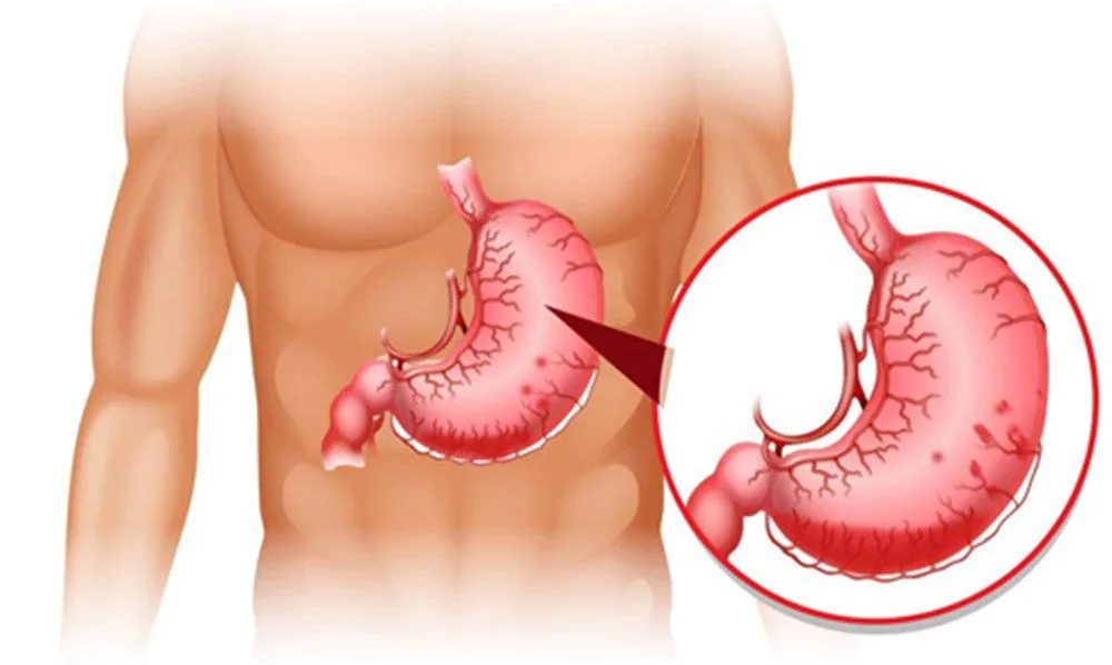 Bệnh viện Sante - Sa dạ dày - Nguyên nhân triệu chứng và cách điều trị Bệnh viện Sante - Sa dạ dày - Nguyên nhân triệu chứng và cách điều trị