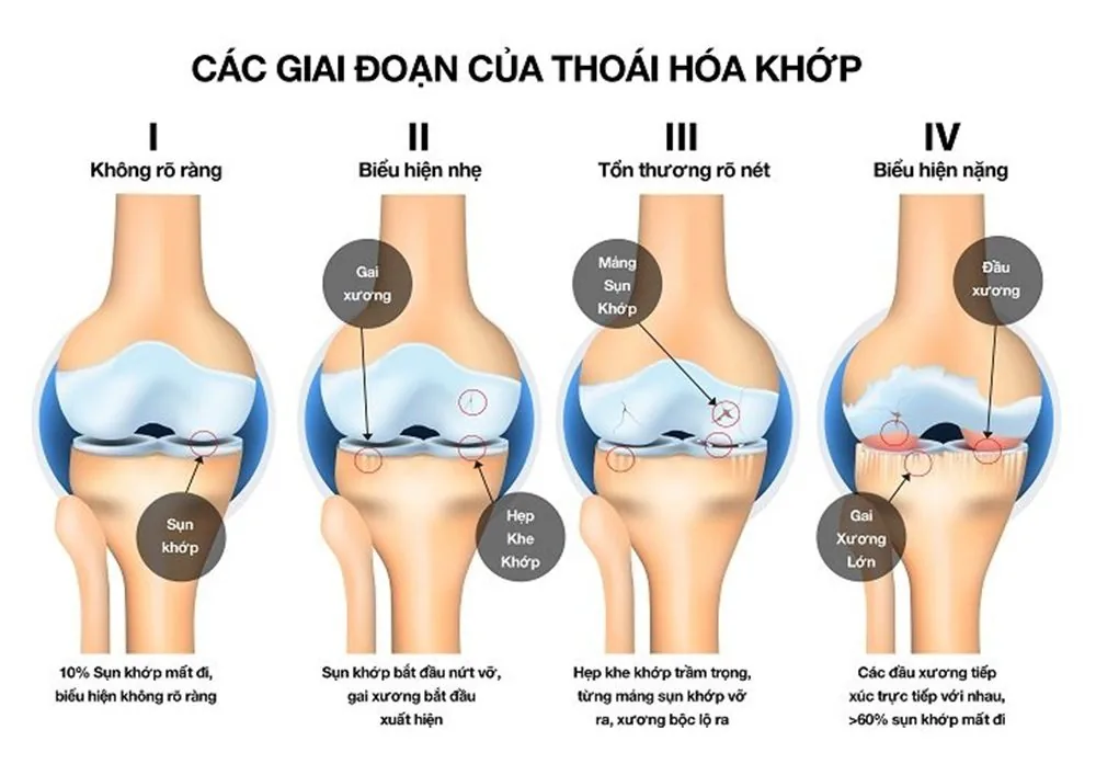 상테 병원 - 퇴행성 관절염 상테 병원 - 퇴행성 관절염