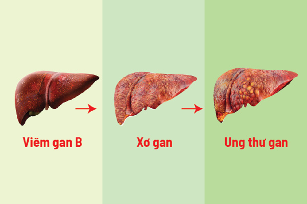 간경변증과 간암은 같은 질환일까요? 구별 증상