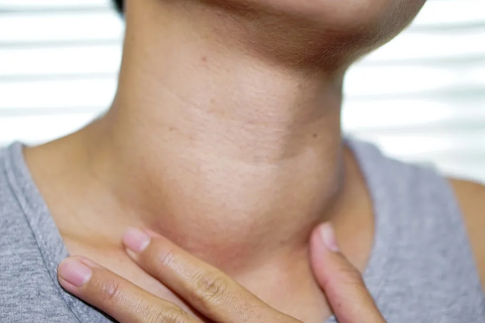 Bướu cổ nguyên nhân và cách phòng tránh 1 Bướu cổ nguyên nhân và cách phòng tránh 1 - Bệnh viện SANTE Bình Thạnh, TP.HCM