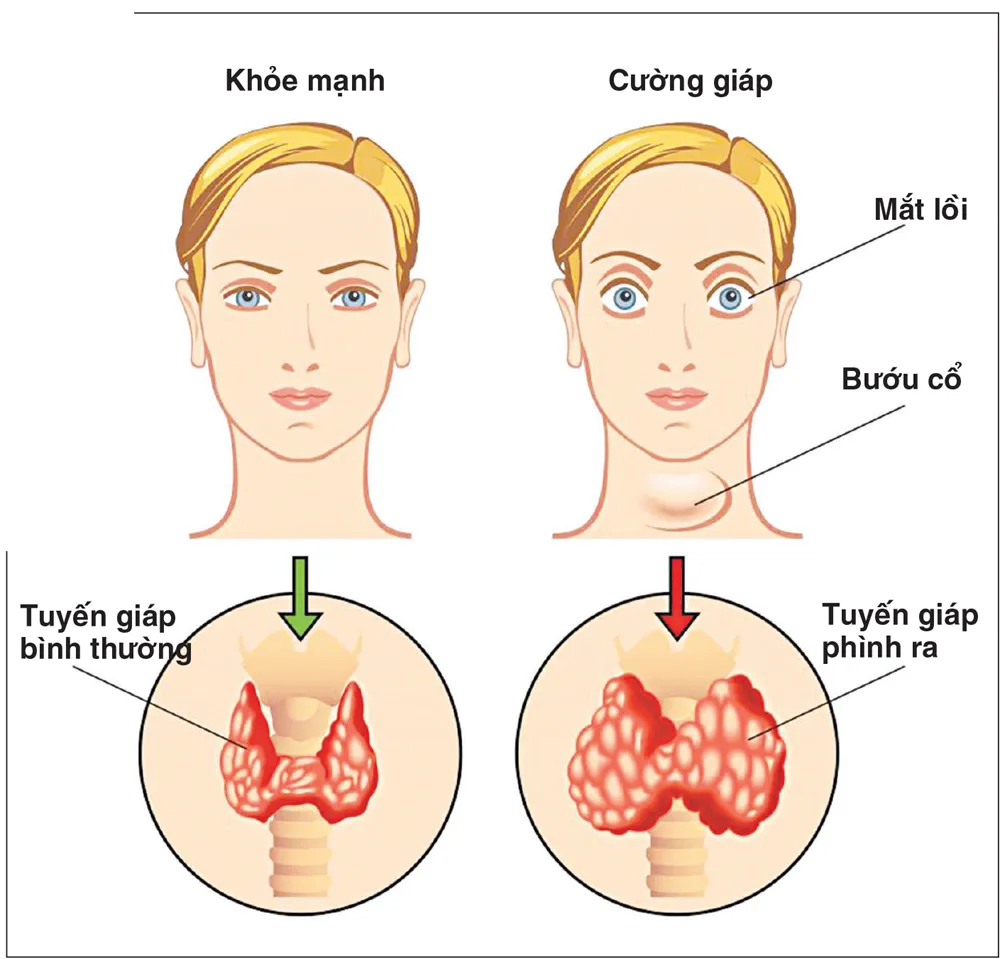 Bướu cổ nguyên nhân và cách phòng tránh 2 Bướu cổ nguyên nhân và cách phòng tránh 2 - Bệnh viện SANTE Bình Thạnh, TP.HCM