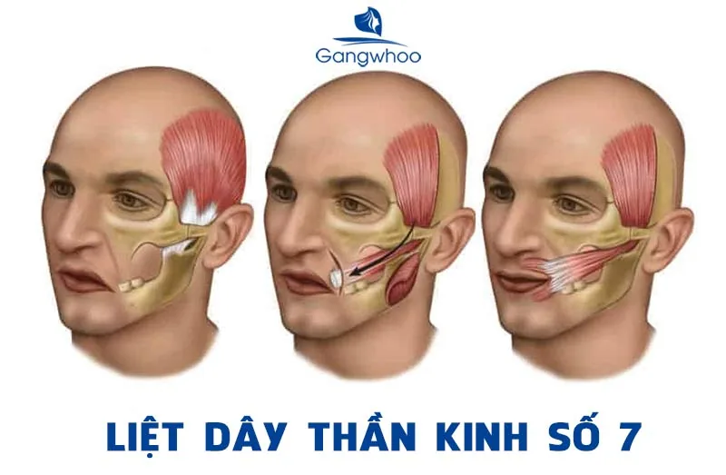 Peripheral facial nerve palsy (Bell's palsy), A CONDITION CAUSING FACIAL ASYMMETRY AND DEFORMITY - Image 2 - SANTE Hospital, Binh Thanh, HCMC Peripheral facial nerve palsy (Bell's palsy), A CONDITION CAUSING FACIAL ASYMMETRY AND DEFORMITY - Image 2 - SANTE Hospital, Binh Thanh, HCMC