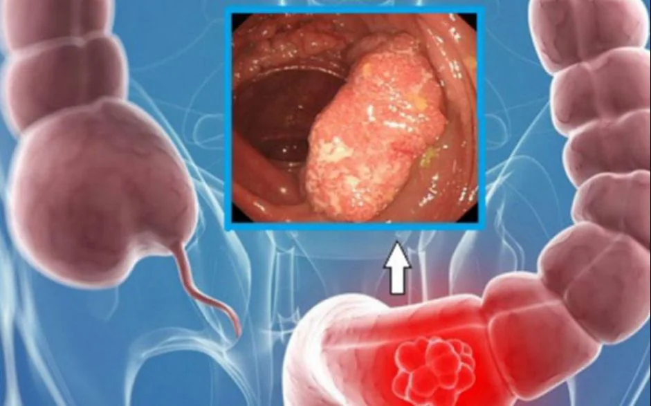 Colorectal Cancer Screening Modalities - Image 2 - SANTE Hospital, Binh Thanh, HCMC Colorectal Cancer Screening Modalities - Image 2 - SANTE Hospital, Binh Thanh, HCMC