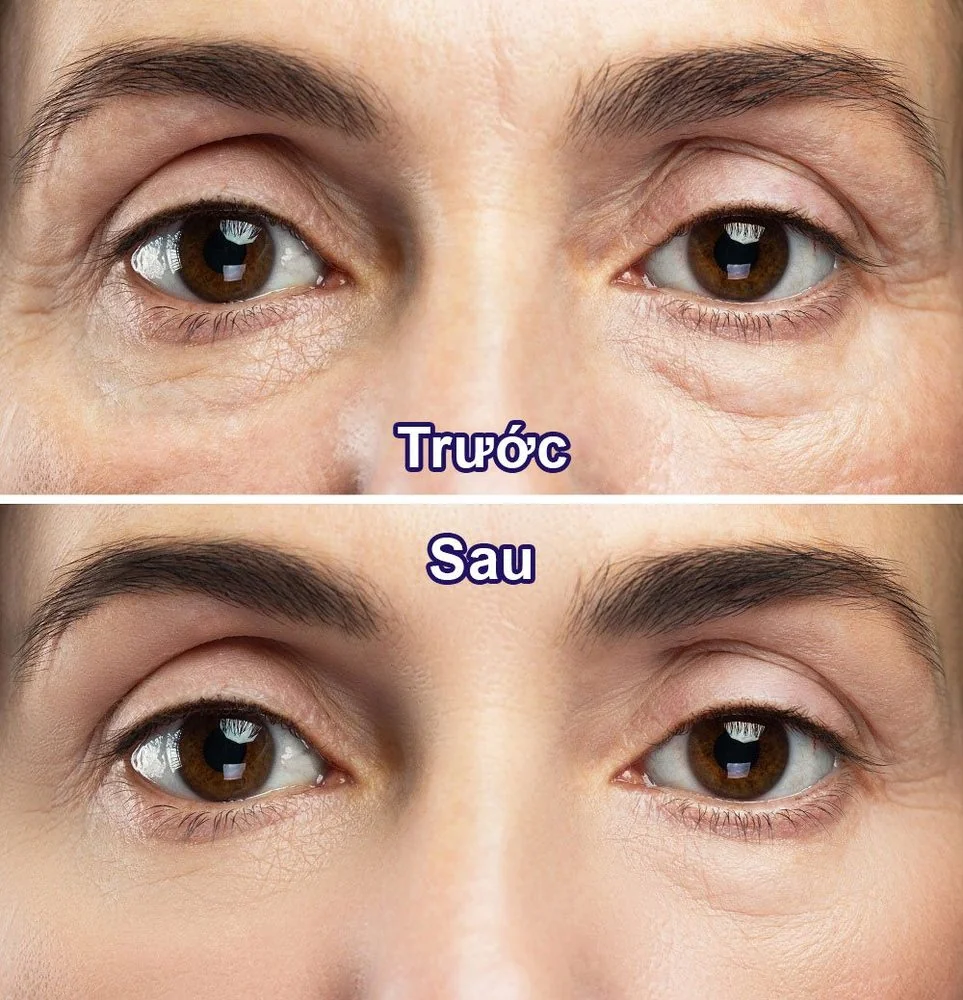 Bệnh viện Sante - Phẫu thuật tạo hình thẩm mỹ mắt (Hình 3) Bệnh viện Sante - Phẫu thuật tạo hình thẩm mỹ mắt (Hình 3)