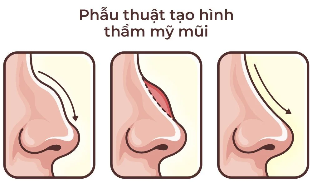 심미 코 성형수술