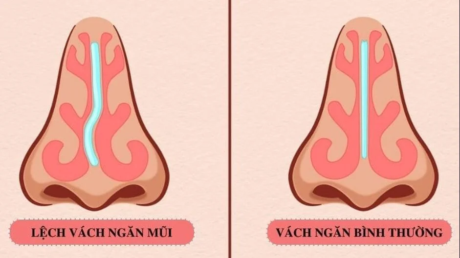 산테 병원 - 비중격만곡증: 언제 수술이 필요할까요? (그림 2) 산테 병원 - 비중격만곡증: 언제 수술이 필요할까요? (그림 2)
