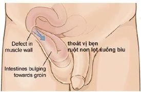 Bệnh viện Sante - Bệnh thoát vị bẹn Bệnh viện Sante - Bệnh thoát vị bẹn
