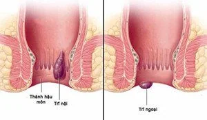 Sante Hospital - Hemorrhoidal Disease Sante Hospital - Hemorrhoidal Disease