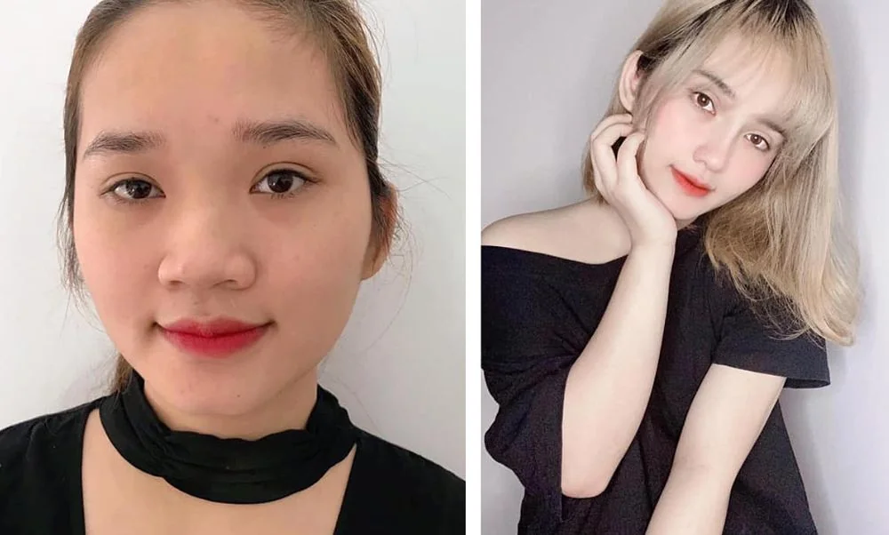 Sante Hospital - Plastic surgery completely transforms facial appearance (Figure 3) Sante Hospital - Plastic surgery completely transforms facial appearance (Figure 3)