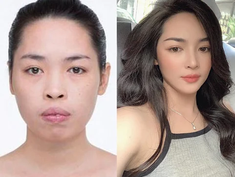 Sante Hospital - Plastic surgery completely transforms facial appearance (Figure 5) Sante Hospital - Plastic surgery completely transforms facial appearance (Figure 5)
