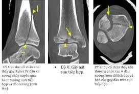 CT scan gãy đầu dưới xương chày - Bệnh viện SANTE Bình Thạnh, TP.HCM
