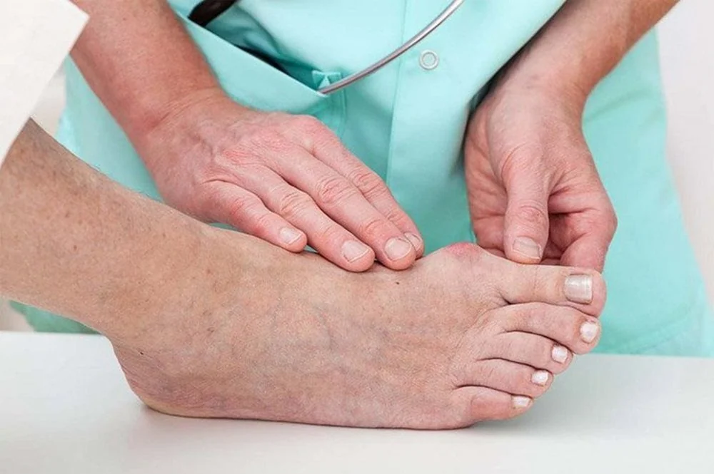 Sante Hospital - Gout - No Longer a Disease of the Affluent Sante Hospital - Gout - No Longer a Disease of the Affluent