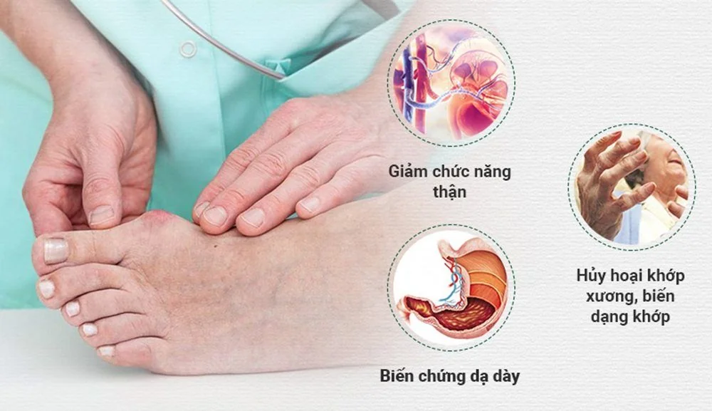 Sante Hospital - Gout - No Longer a Disease of the Affluent (Figure 3) Sante Hospital - Gout - No Longer a Disease of the Affluent (Figure 3)
