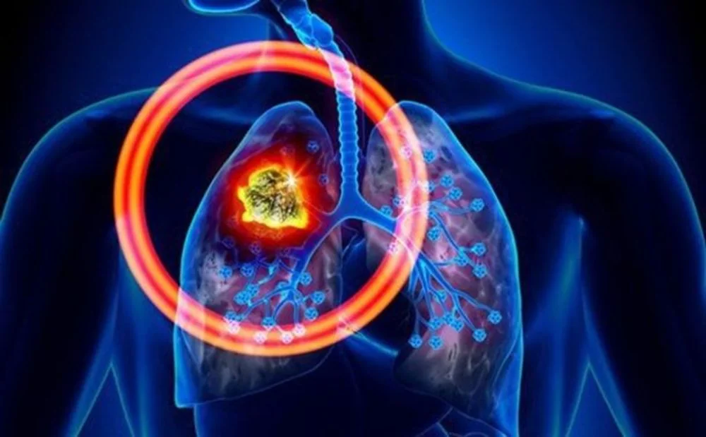 Bệnh viện Sante - Các loại ung thư phổi_ nhận biết_ cách phòng tránh hiệu quả Bệnh viện Sante - Các loại ung thư phổi_ nhận biết_ cách phòng tránh hiệu quả