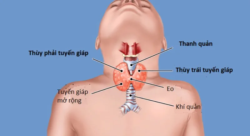 산테 병원 - 갑상선기능항진증이란 무엇인가요? 원인, 징후 및 치료법 산테 병원 - 갑상선기능항진증이란 무엇인가요? 원인, 징후 및 치료법