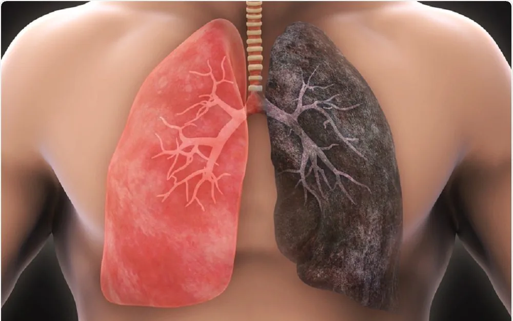 Sante Hospital - Causes of Lung Cancer, Risk Factors, and Prevention Methods (Image 4) Sante Hospital - Causes of Lung Cancer, Risk Factors, and Prevention Methods (Image 4)