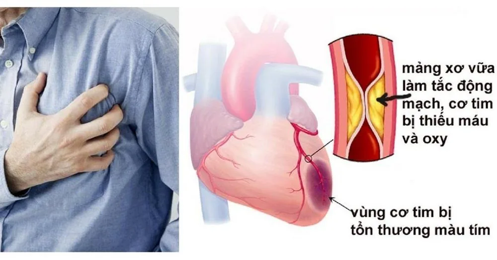 Bệnh viện Sante - Nhồi máu cơ tim - Hướng dẫn sơ cứu tại nhà (Hình 2) Bệnh viện Sante - Nhồi máu cơ tim - Hướng dẫn sơ cứu tại nhà (Hình 2)