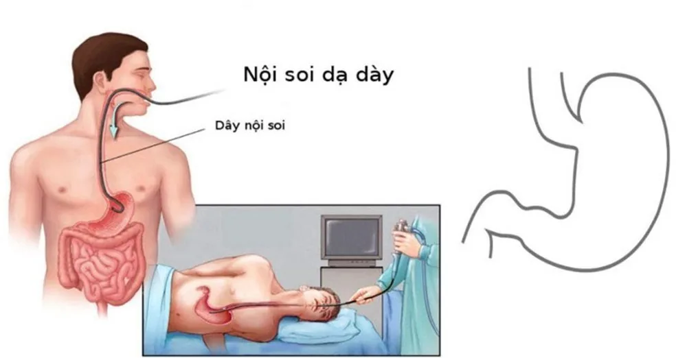 Bệnh viện Sante - Những điều cần biết về viêm loét dạ dày (Hình 3) Bệnh viện Sante - Những điều cần biết về viêm loét dạ dày (Hình 3)