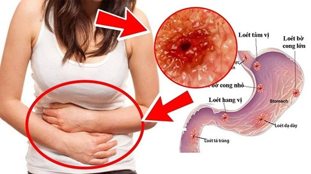 Bệnh viện Sante - Những điều cần biết về viêm loét dạ dày (Hình 2) Bệnh viện Sante - Những điều cần biết về viêm loét dạ dày (Hình 2)