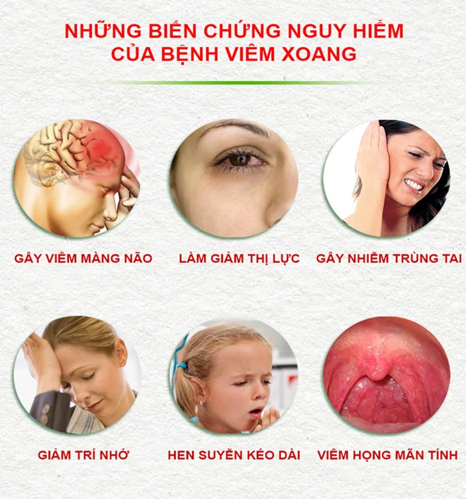 Sante Hospital - Rhinosinusitis and its unforeseen dangers (Figure 3) Sante Hospital - Rhinosinusitis and its unforeseen dangers (Figure 3)