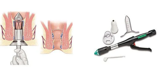 Sante Hospital - Hemorrhoidal Disease (Image 2) Sante Hospital - Hemorrhoidal Disease (Image 2)