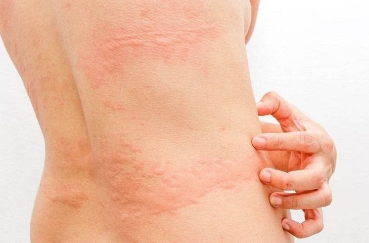 보호자가 꼭 알아두어야 할 소아 두드러기의 올바른 관리 및 대처법