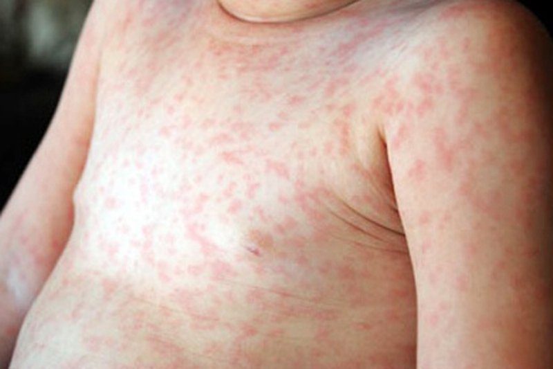 Rashes in children: Symptoms, care, and effective treatment methods