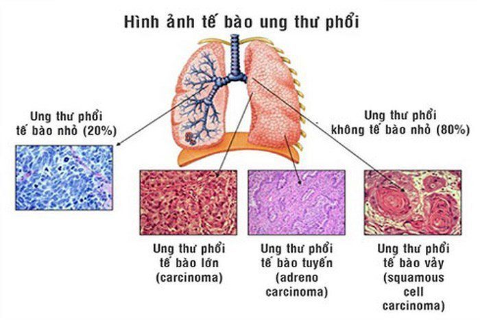 Types of lung cancer, recognition, and effective prevention methods