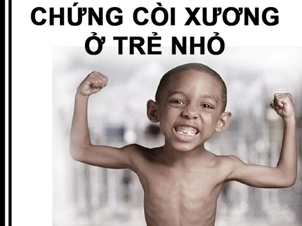 구루병이란 어떤 질환인가요? 주요 증상 및 전문 진단 가이드