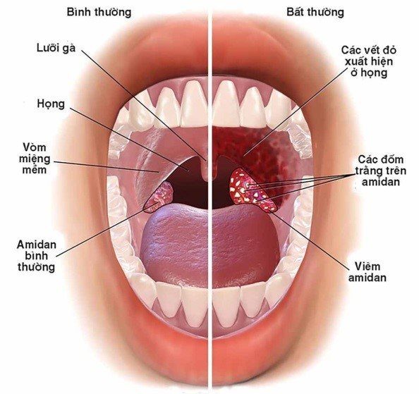 인후통의 원인은 무엇인가요? 증상 및 치료 방법.