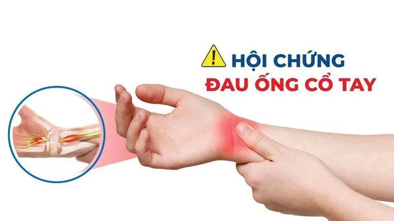 수근관 증후군 (손목 터널 증후군)