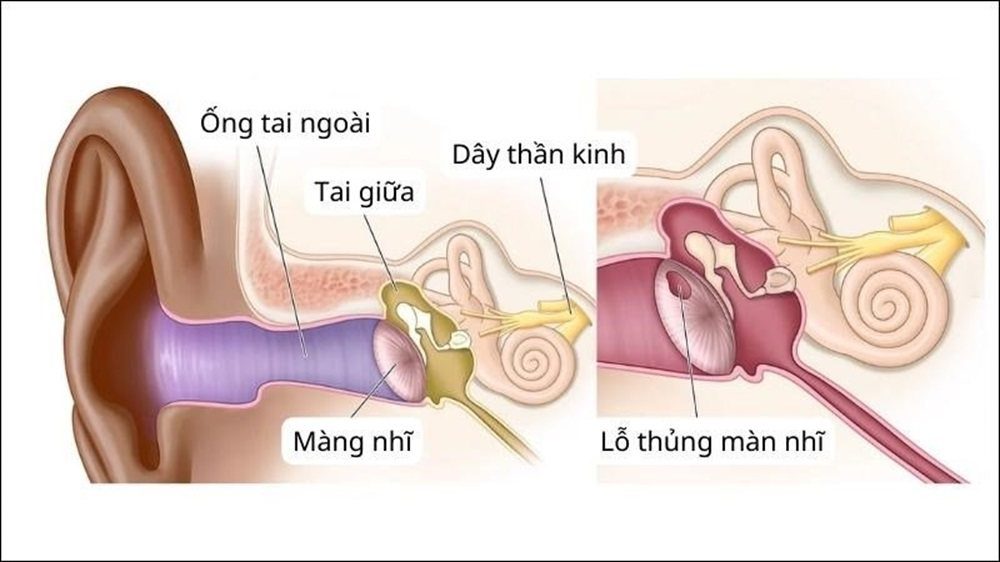 고막 천공 – 원인, 증상 및 예방법