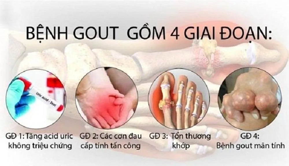 Gout: Dispelling the Myth of the 'Disease of the Affluent'
