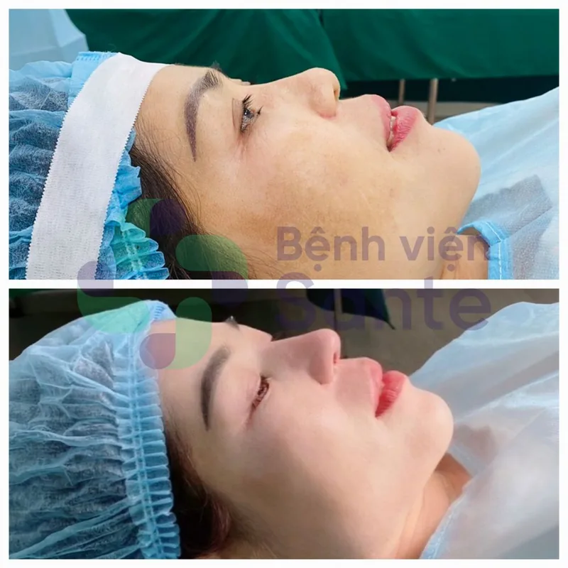 코 성형술이란? 호치민 국제 표준 프리미엄 코 성형 전문 병원