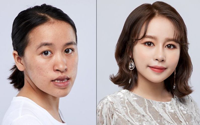 완전한 이미지 개선을 위한 풀페이스 맞춤 안면 성형술