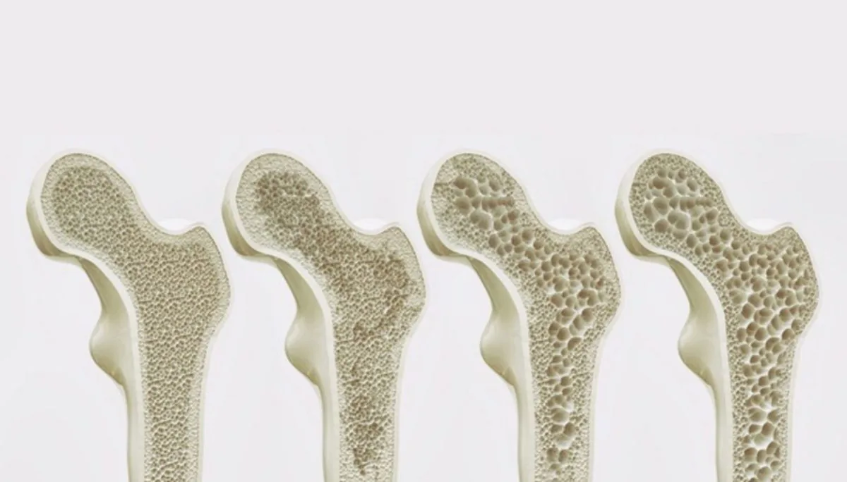 EARLY DETECTION OF OSTEOPOROSIS FOR OPTIMAL BONE HEALTH PRESERVATION - Image 3 - SANTE Hospital, Binh Thanh, HCMC EARLY DETECTION OF OSTEOPOROSIS FOR OPTIMAL BONE HEALTH PRESERVATION - Image 3 - SANTE Hospital, Binh Thanh, HCMC