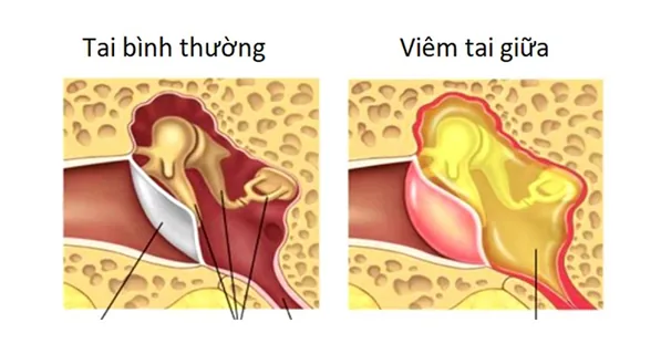 귀의 화농성 이루(고름)의 위험성 및 전문적 대처 가이드 - 산테(SANTE) 병원, 호치민시 빈탄 귀의 화농성 이루(고름)의 위험성 및 전문적 대처 가이드 - 산테(SANTE) 병원, 호치민시 빈탄